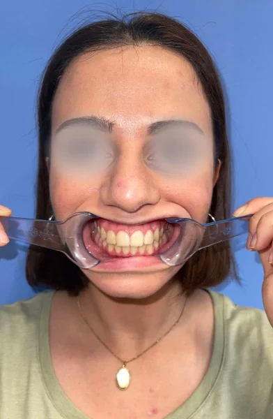 Cas 17