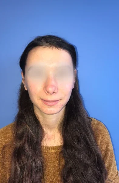Cas 14