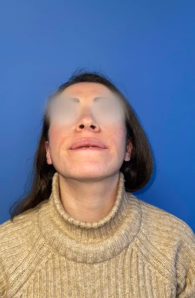 Cas 23