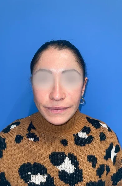 Cas 23