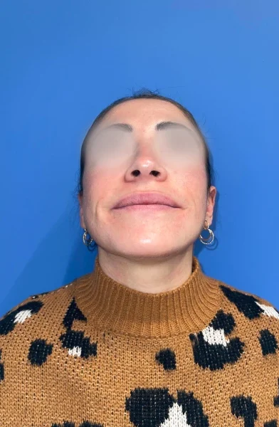 Cas 23